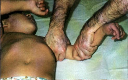 Miofaszciális technika alkalmazása a felső
végtagon, mellyel létrejön a kar nyújtási funkciója