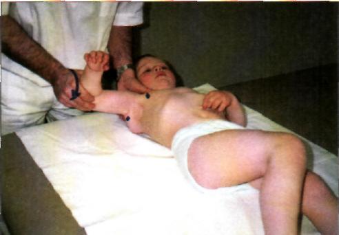 Akupersszúrás pontok ingerlésével
elősegíthető a vállizület mozgása